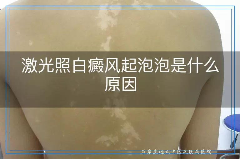 激光照白癜风起泡泡是什么原因