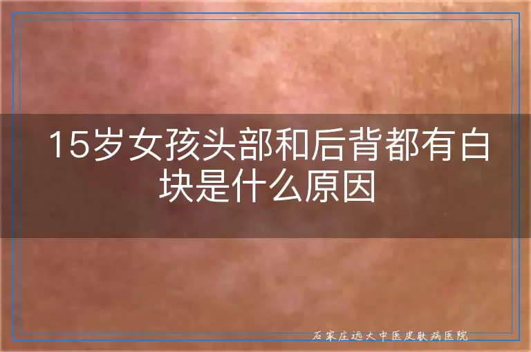 15岁女孩头部和后背都有白块是什么原因