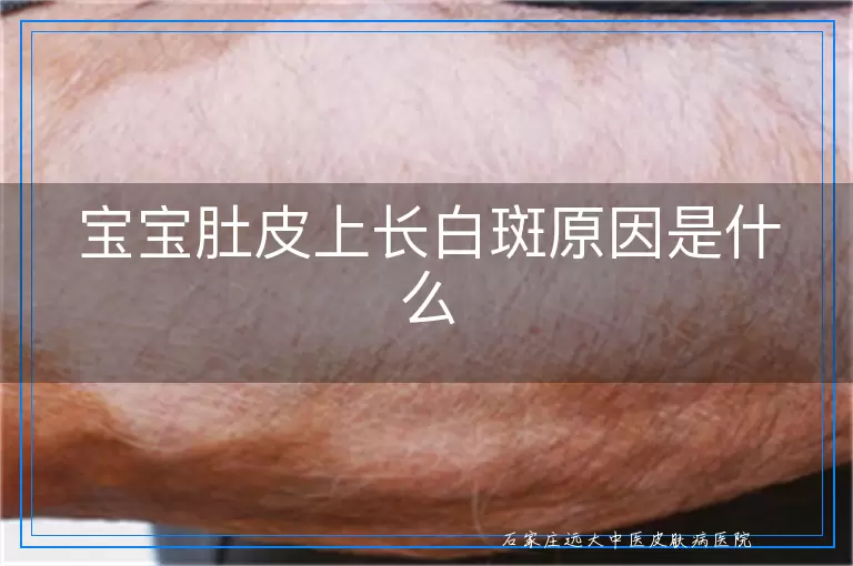 宝宝肚皮上长白斑原因是什么