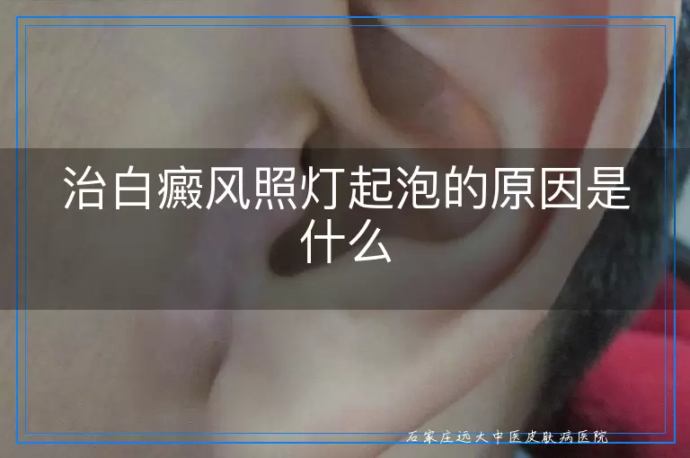 治白癜风照灯起泡的原因是什么