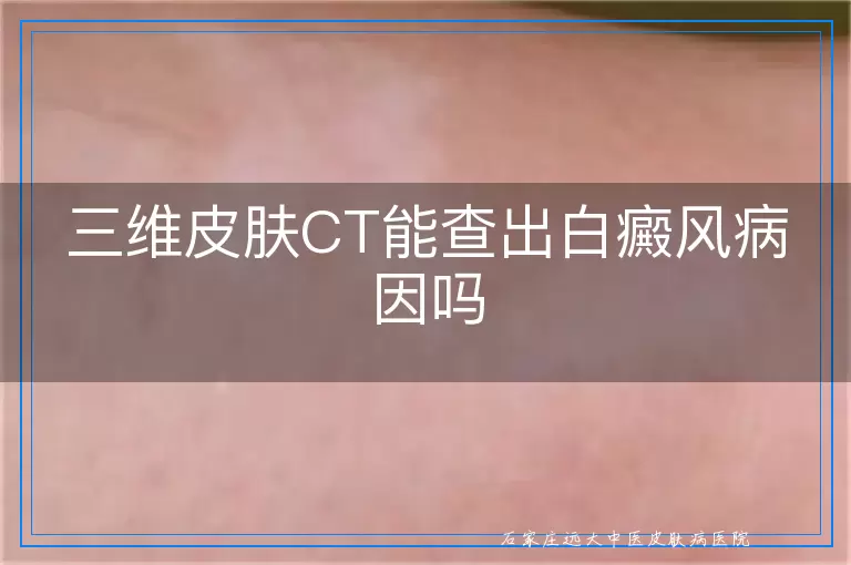 三维皮肤CT能查出白癜风病因吗