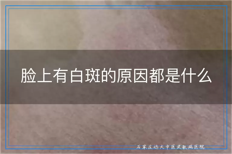 脸上有白斑的原因都是什么