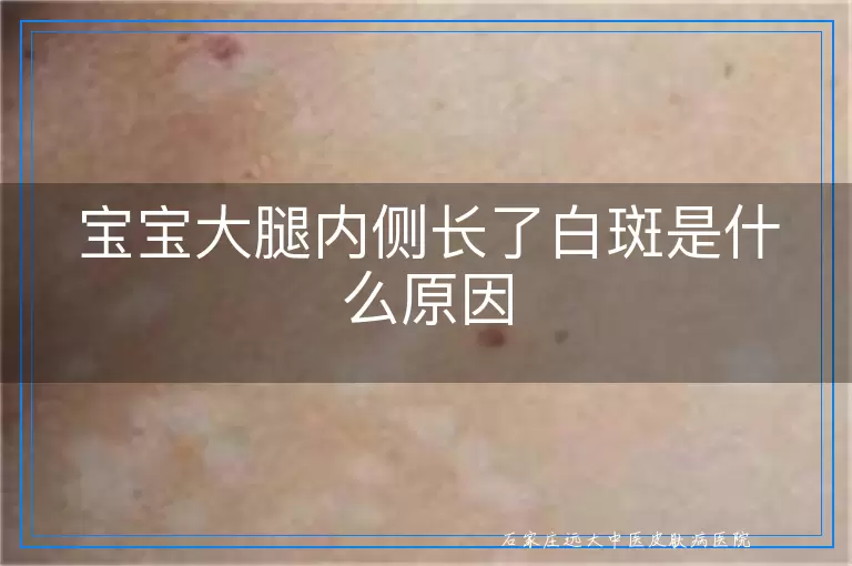 宝宝大腿内侧长了白斑是什么原因