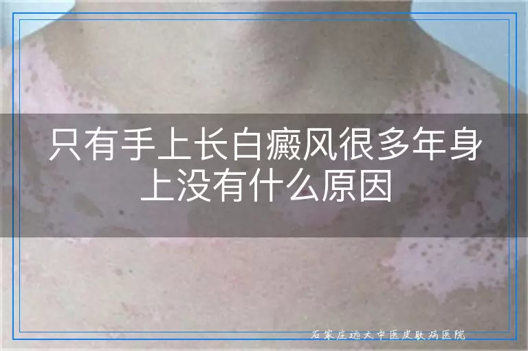只有手上长白癜风很多年身上没有什么原因
