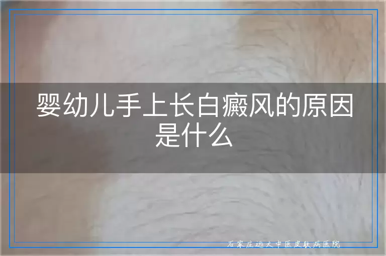 婴幼儿手上长白癜风的原因是什么
