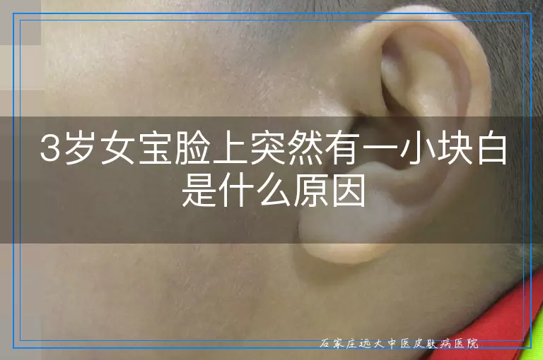 3岁女宝脸上突然有一小块白是什么原因