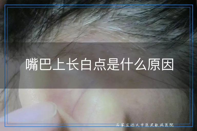 嘴巴上长白点是什么原因