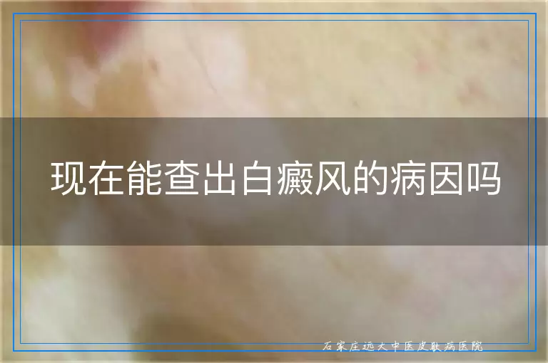 现在能查出白癜风的病因吗
