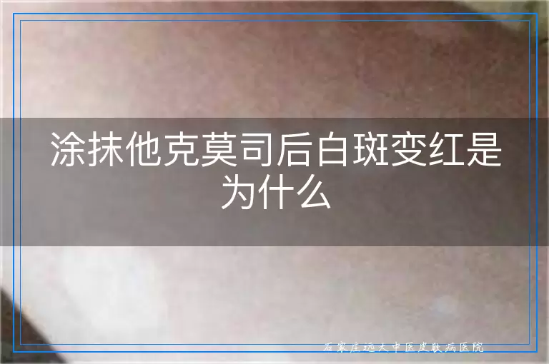 涂抹他克莫司后白斑变红是为什么