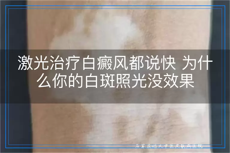 激光治疗白癜风都说快 为什么你的白斑照光没效果
