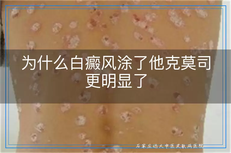 为什么白癜风涂了他克莫司更明显了