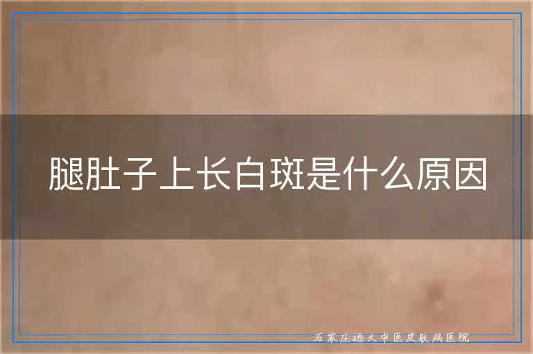 腿肚子上长白斑是什么原因