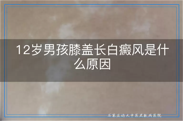 12岁男孩膝盖长白癜风是什么原因