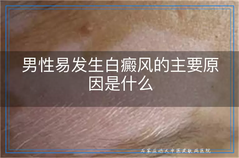 男性易发生白癜风的主要原因是什么