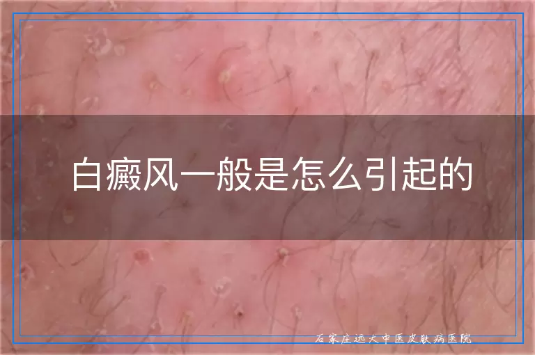 白癜风一般是怎么引起的