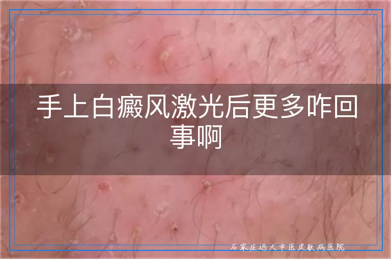 手上白癜风激光后更多咋回事啊