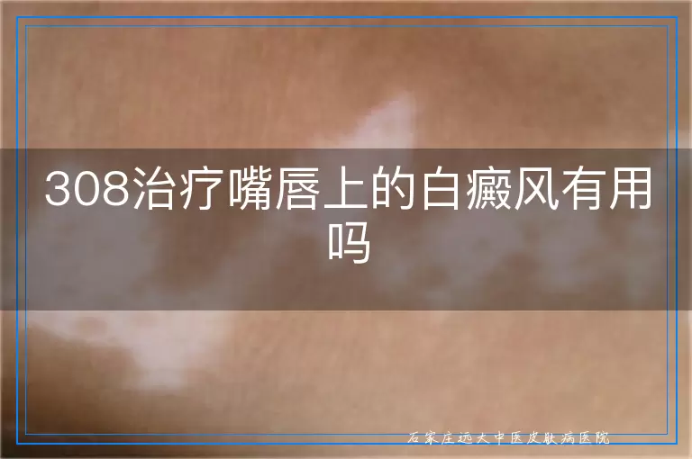 308治疗嘴唇上的白癜风有用吗