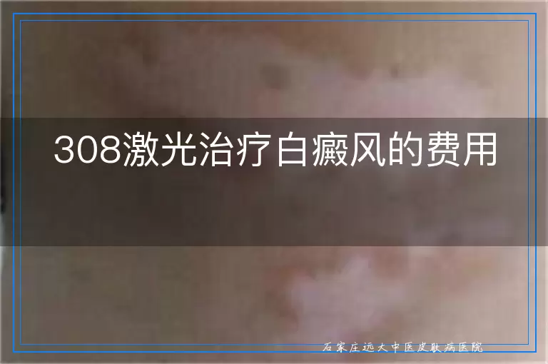 308激光治疗白癜风的费用