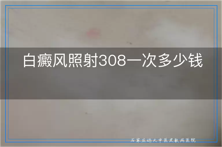 白癜风照射308一次多少钱