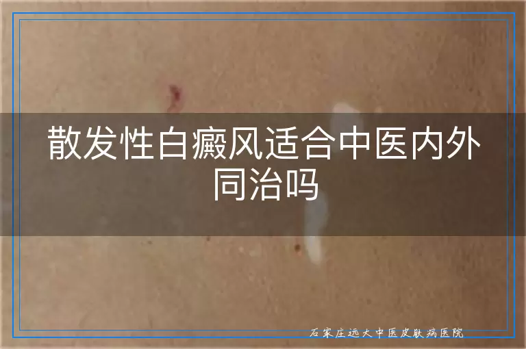 散发性白癜风适合中医内外同治吗