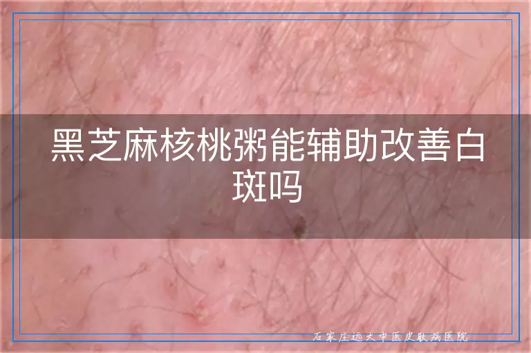 黑芝麻核桃粥能辅助改善白斑吗