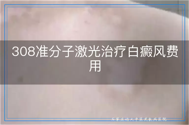 308准分子激光治疗白癜风费用