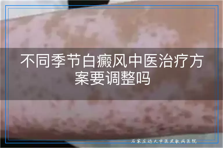不同季节白癜风中医治疗方案要调整吗