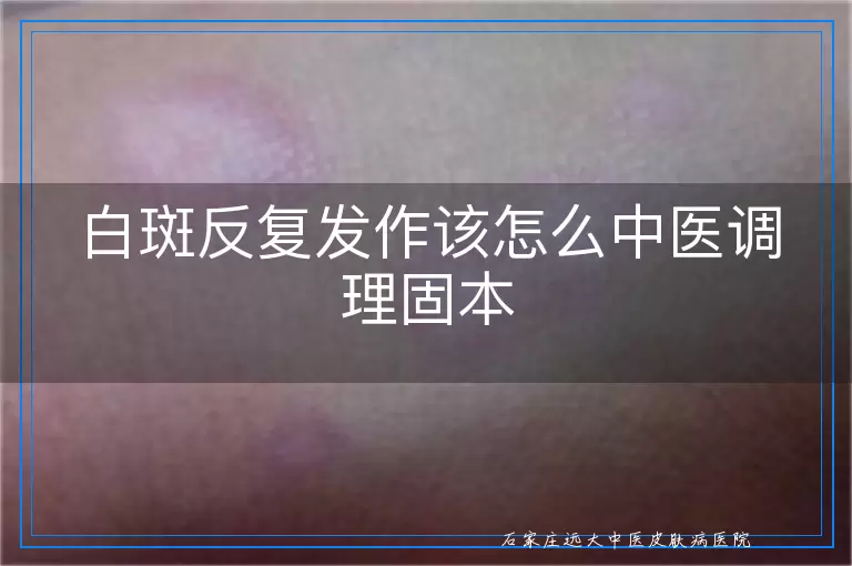 白斑反复发作该怎么中医调理固本