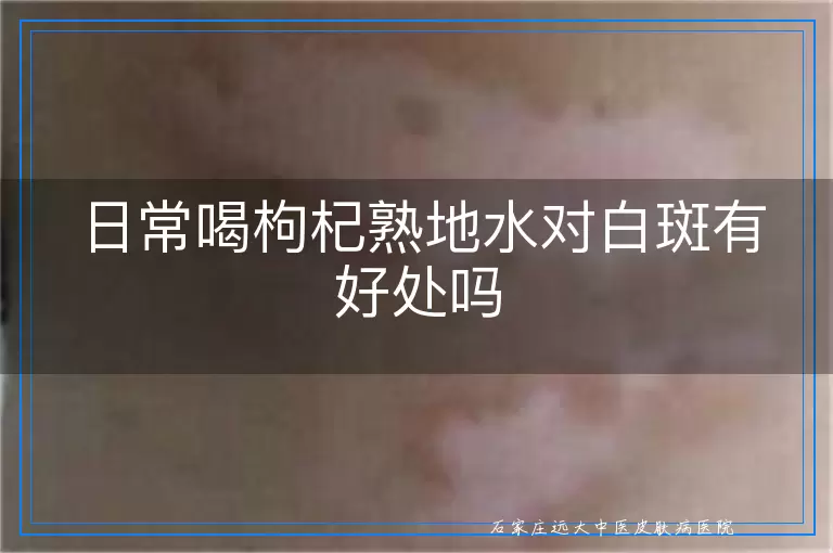 日常喝枸杞熟地水对白斑有好处吗