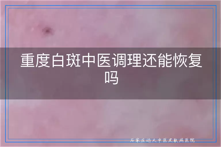 重度白斑中医调理还能恢复吗