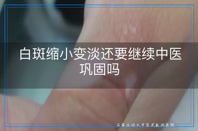 白斑缩小变淡还要继续中医巩固吗