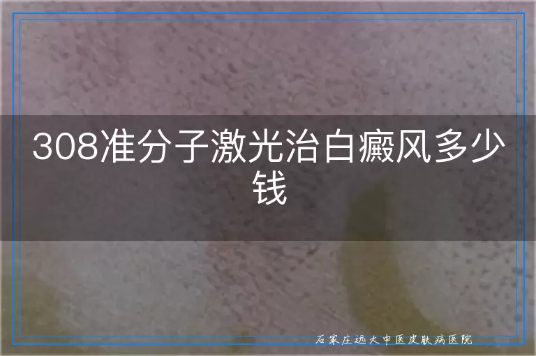 308准分子激光治白癜风多少钱