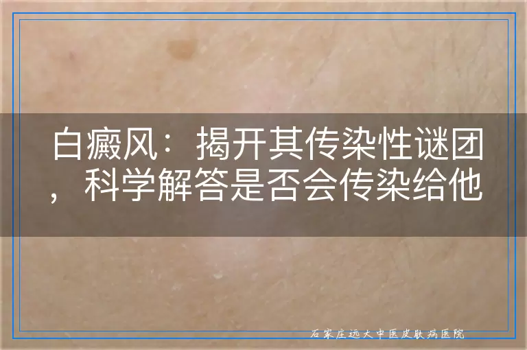 白癜风：揭开其传染性谜团，科学解答是否会传染给他人