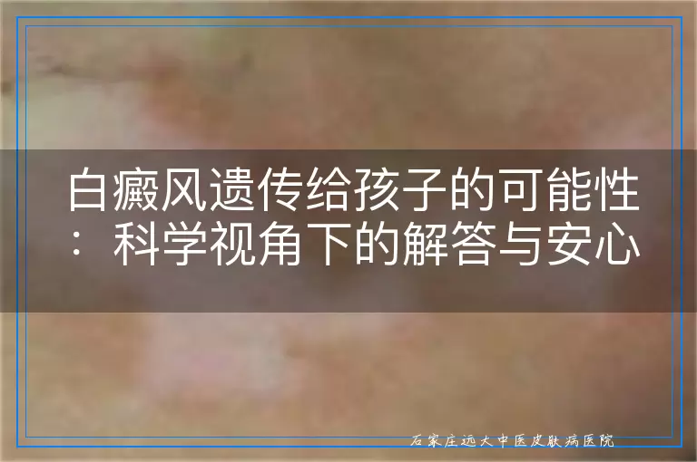 白癜风遗传给孩子的可能性：科学视角下的解答与安心指南