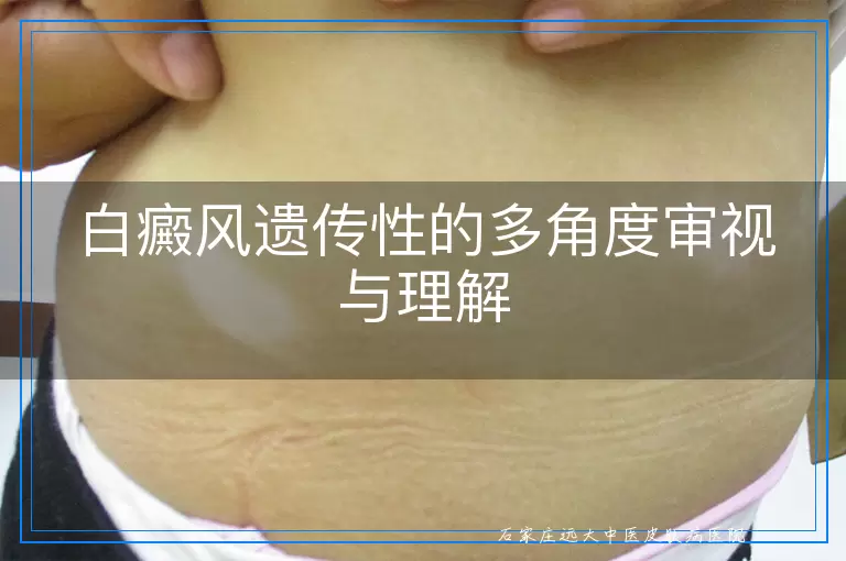 白癜风遗传性的多角度审视与理解
