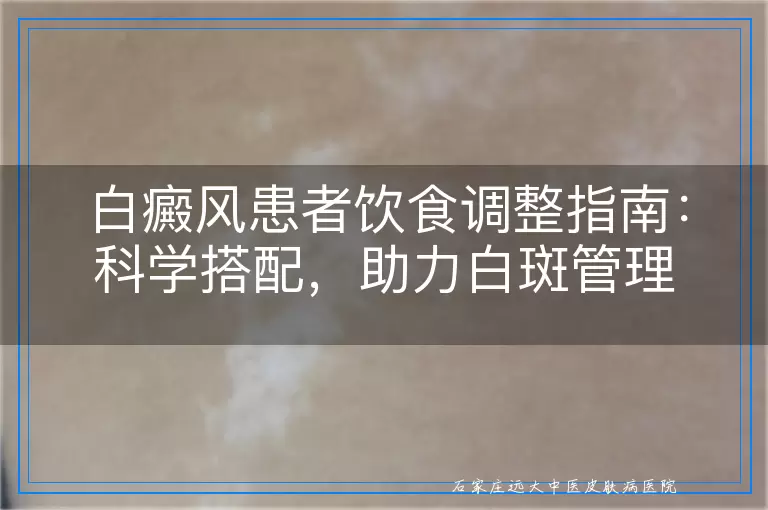 白癜风患者饮食调整指南：科学搭配，助力白斑管理