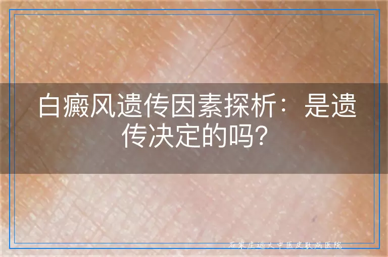 白癜风遗传因素探析：是遗传决定的吗？