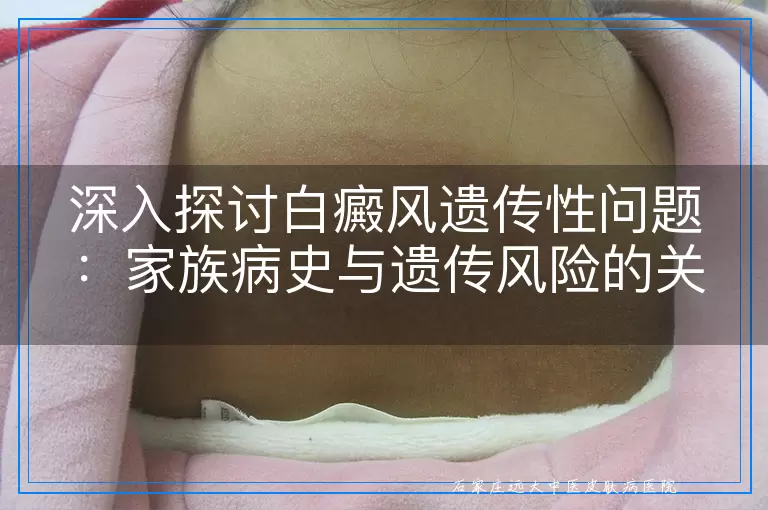 深入探讨白癜风遗传性问题：家族病史与遗传风险的关联