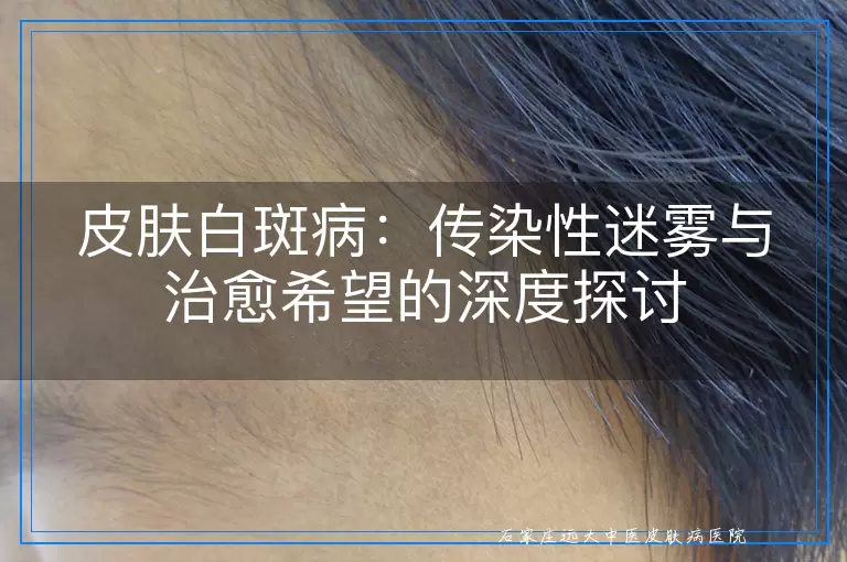 皮肤白斑病：传染性迷雾与治愈希望的深度探讨