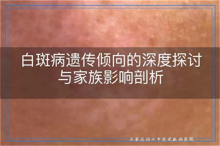 白斑病遗传倾向的深度探讨与家族影响剖析