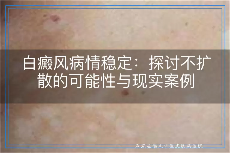 白癜风病情稳定：探讨不扩散的可能性与现实案例