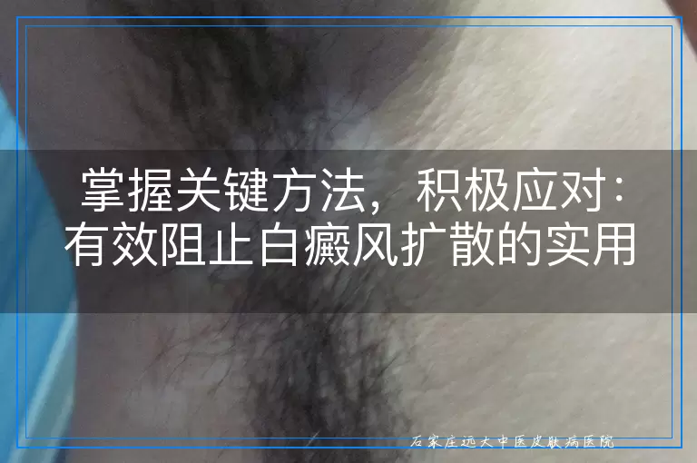 掌握关键方法，积极应对：有效阻止白癜风扩散的实用指南