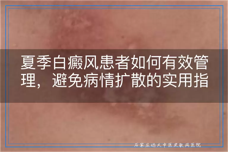 夏季白癜风患者如何有效管理，避免病情扩散的实用指南