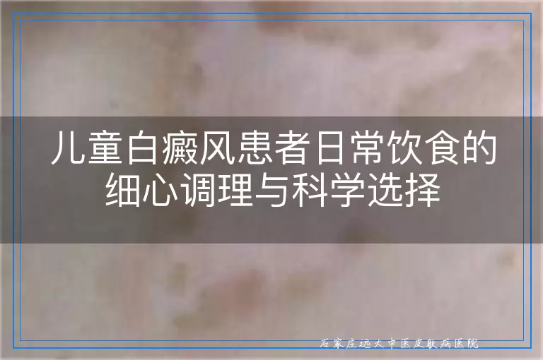 儿童白癜风患者日常饮食的细心调理与科学选择