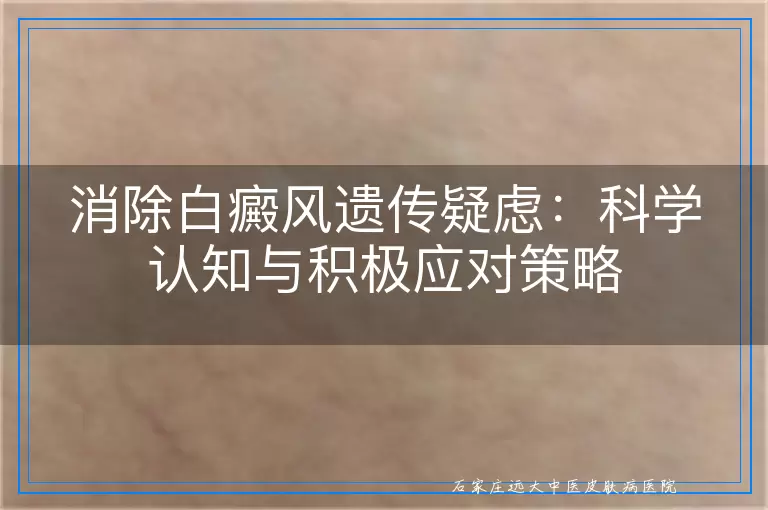 消除白癜风遗传疑虑：科学认知与积极应对策略