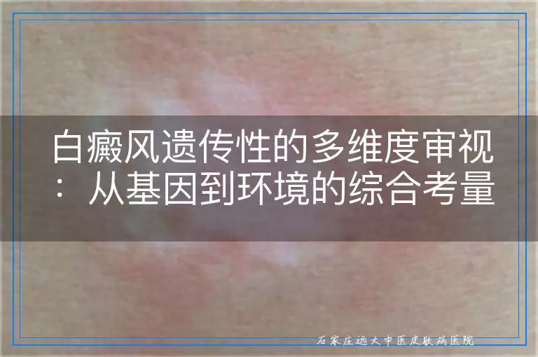 白癜风遗传性的多维度审视：从基因到环境的综合考量