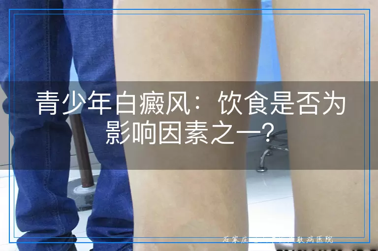 青少年白癜风：饮食是否为影响因素之一？