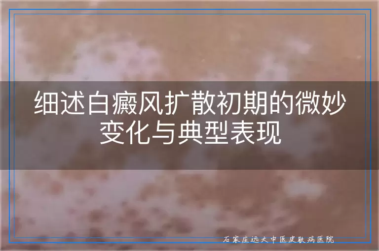 细述白癜风扩散初期的微妙变化与典型表现