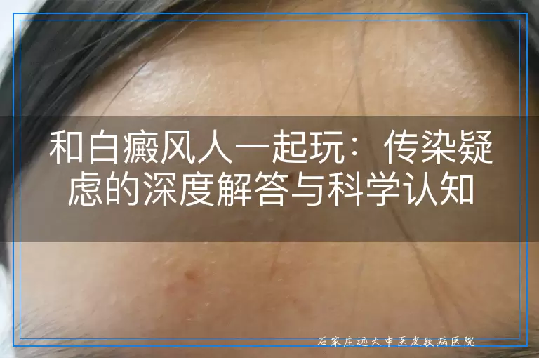 和白癜风人一起玩：传染疑虑的深度解答与科学认知