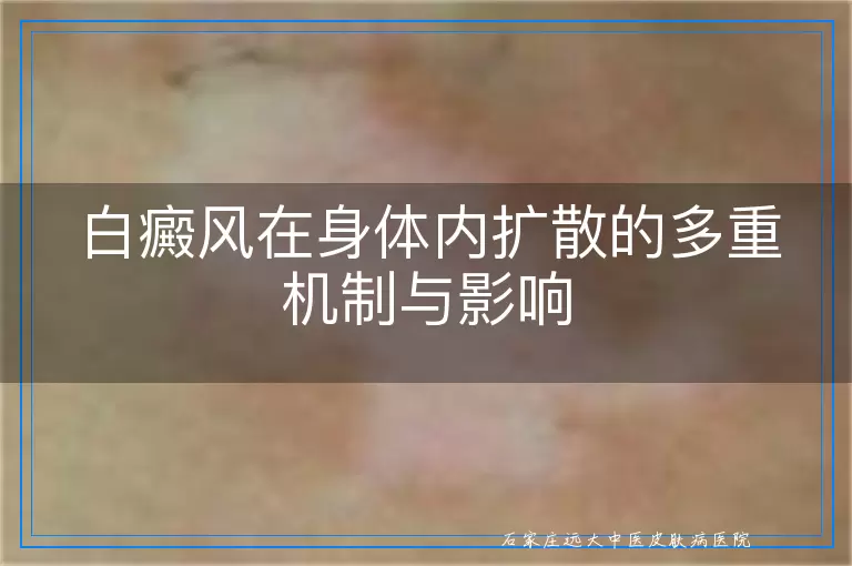 白癜风在身体内扩散的多重机制与影响